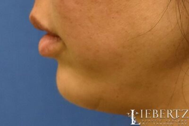 Dermal Fillers Before & After Gallery - Patient 375133 - Image 6