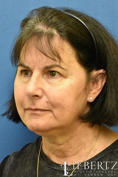 Facelift Before & After Gallery - Patient 214786 - Image 1