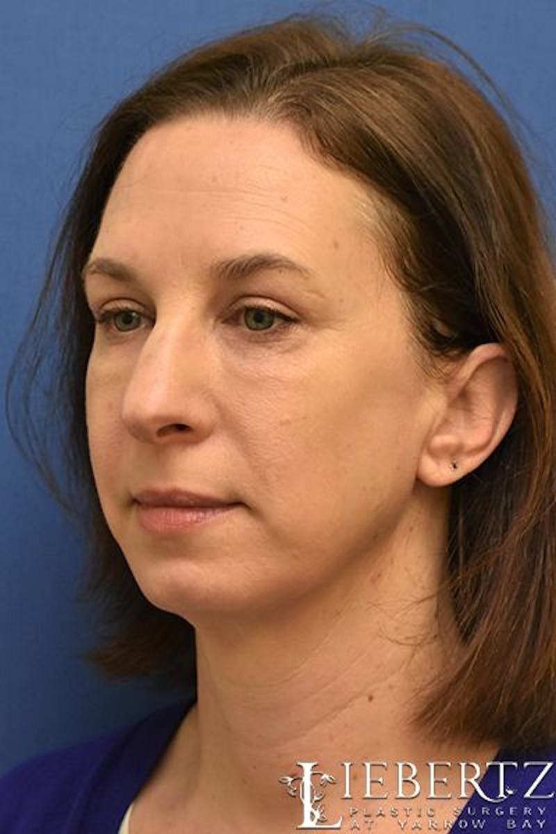 Blepharoplasty Before & After Gallery - Patient 324722 - Image 8