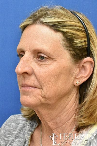 Facelift Before & After Gallery - Patient 171557 - Image 1