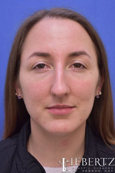 Rhinoplasty Before & After Gallery - Patient 255064 - Image 1