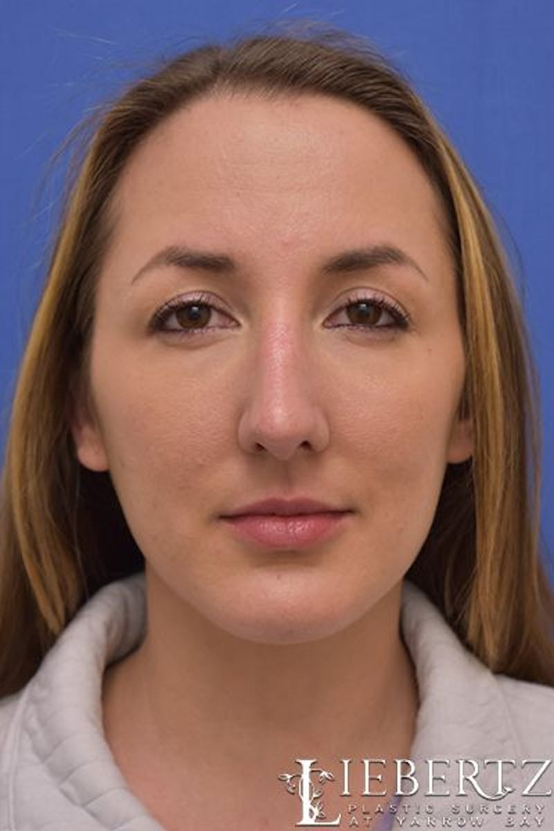Rhinoplasty Before & After Gallery - Patient 255064 - Image 4