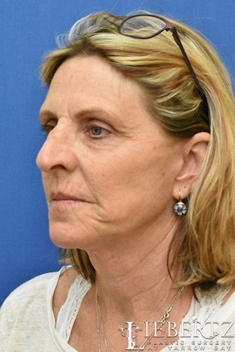 Facelift Before & After Gallery - Patient 171557 - Image 4