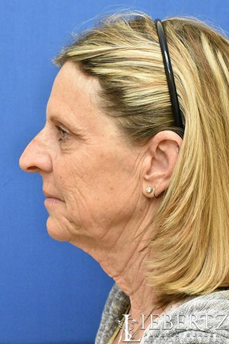 Facelift Before & After Gallery - Patient 171557 - Image 5