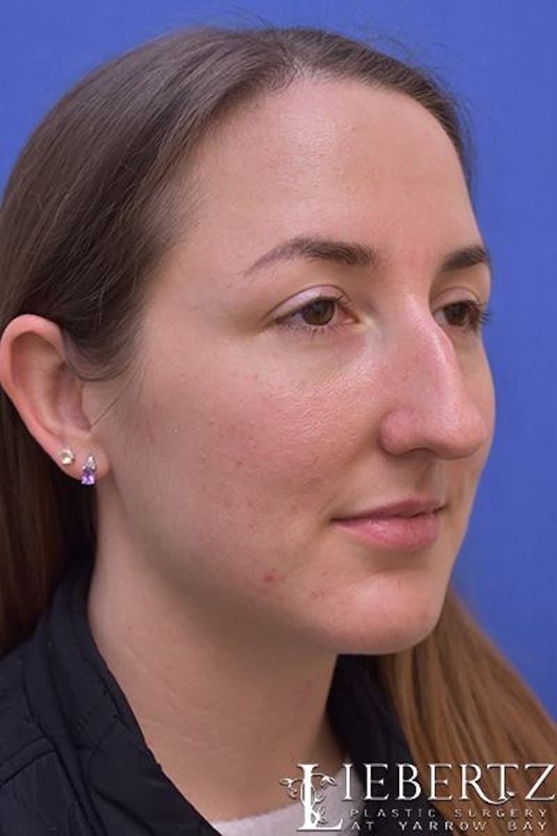 Rhinoplasty Before & After Gallery - Patient 255064 - Image 3