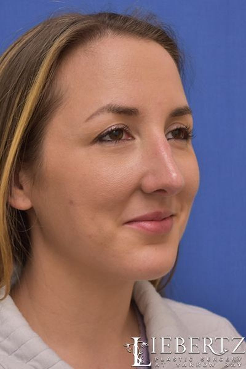 Rhinoplasty Before & After Gallery - Patient 255064 - Image 6