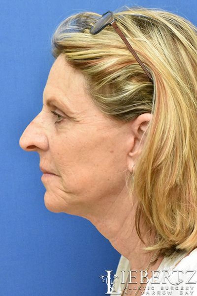 Facelift Before & After Gallery - Patient 171557 - Image 6