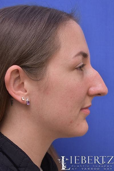 Rhinoplasty Before & After Gallery - Patient 255064 - Image 1