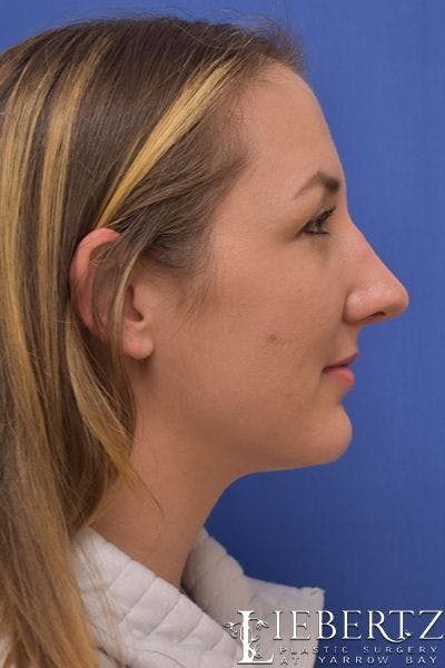 Rhinoplasty Before & After Gallery - Patient 255064 - Image 2