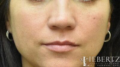 Dermal Fillers Before & After Gallery - Patient 225543 - Image 1