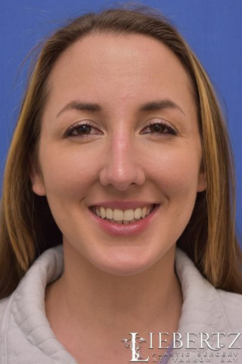 Rhinoplasty Before & After Gallery - Patient 255064 - Image 8
