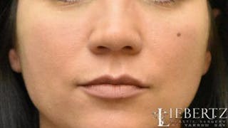 Lip Augmentation Before & After Gallery - Patient 104692 - Image 2