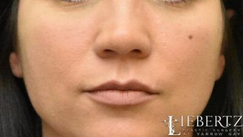 Dermal Fillers Before & After Gallery - Patient 225543 - Image 2