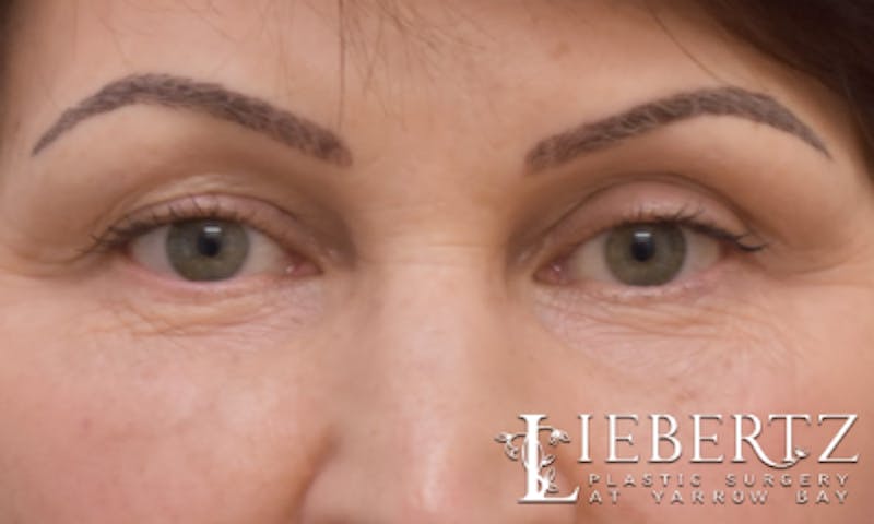 Blepharoplasty Before & After Gallery - Patient 916349 - Image 1