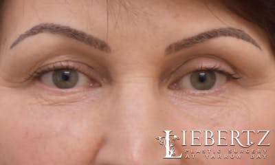 Blepharoplasty Before & After Gallery - Patient 916349 - Image 1