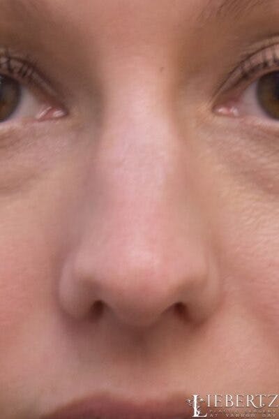 Rhinoplasty Before & After Gallery - Patient 403893 - Image 1