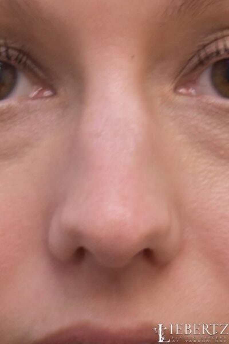 Rhinoplasty Before & After Gallery - Patient 403893 - Image 3