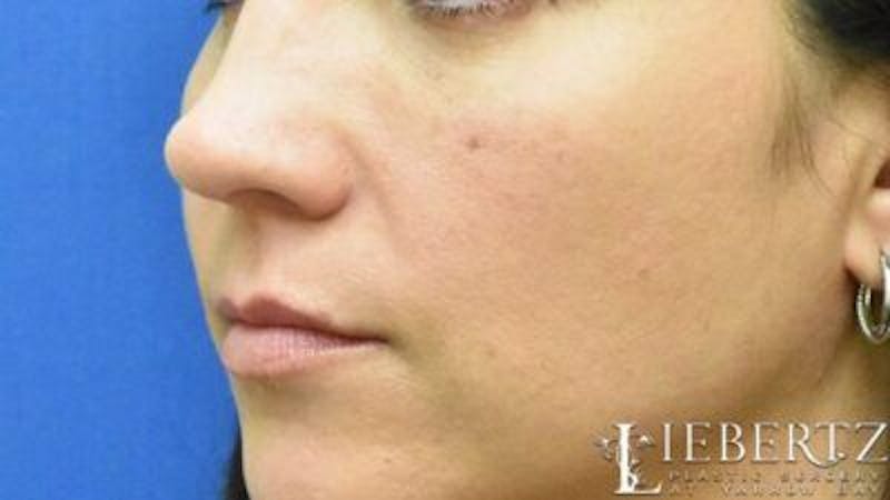Dermal Fillers Before & After Gallery - Patient 225543 - Image 3