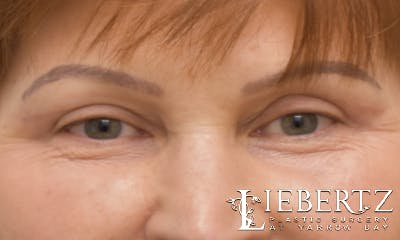 Blepharoplasty Before & After Gallery - Patient 916349 - Image 2