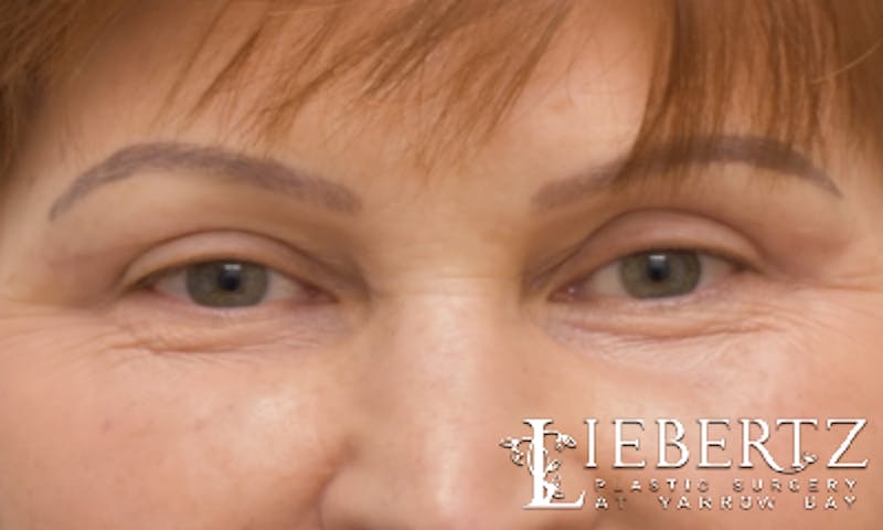 Blepharoplasty Before & After Gallery - Patient 916349 - Image 2
