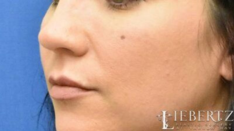 Lip Augmentation Before & After Gallery - Patient 104692 - Image 4