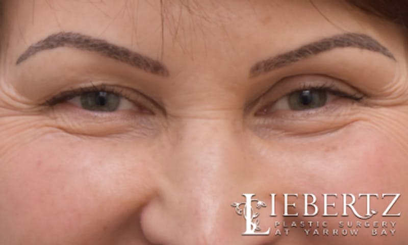 Blepharoplasty Before & After Gallery - Patient 916349 - Image 3