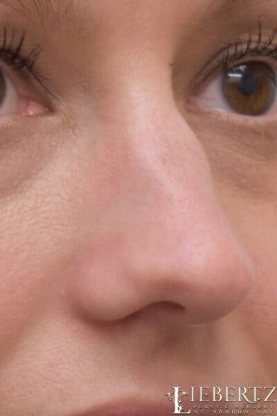 Rhinoplasty Before & After Gallery - Patient 403893 - Image 1