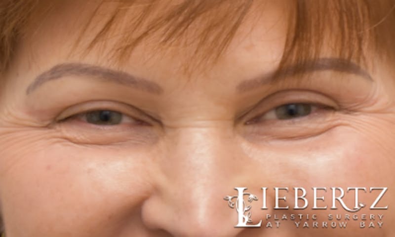 Blepharoplasty Before & After Gallery - Patient 916349 - Image 4