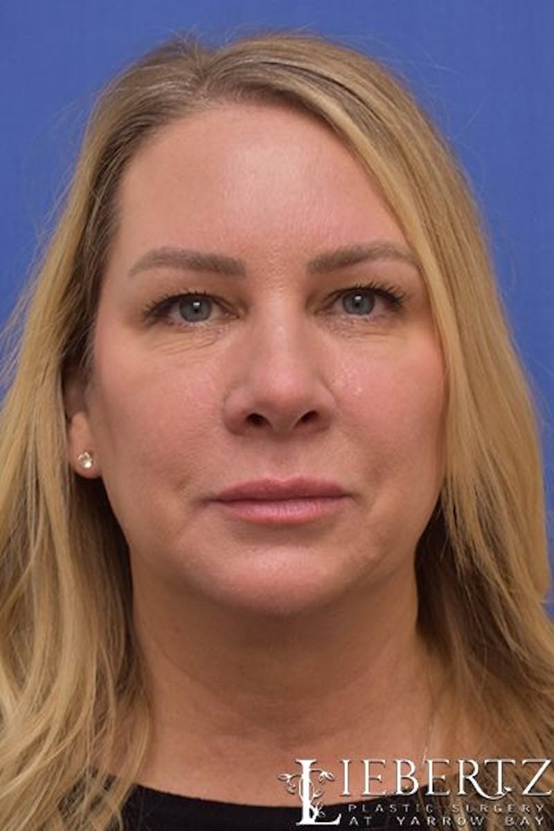 Blepharoplasty Before & After Gallery - Patient 305316 - Image 1
