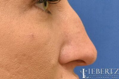 Rhinoplasty Before & After Gallery - Patient 398897 - Image 1