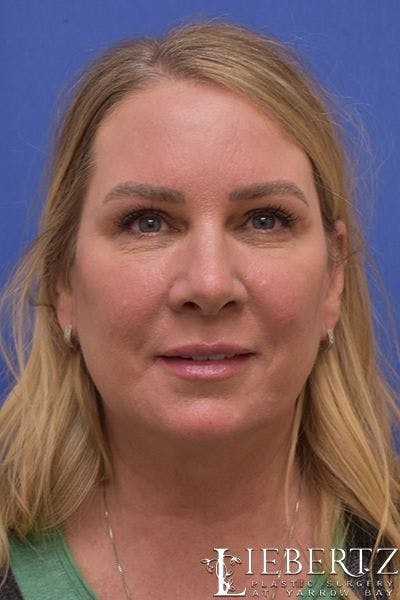 Blepharoplasty Before & After Gallery - Patient 305316 - Image 2