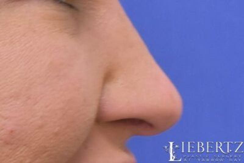 Rhinoplasty Before & After Gallery - Patient 398897 - Image 2