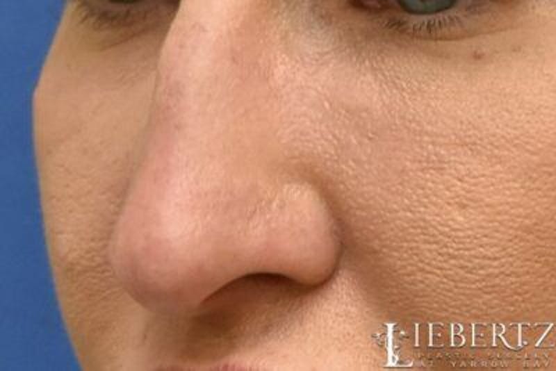 Rhinoplasty Before & After Gallery - Patient 398897 - Image 3