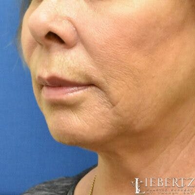 Dermal Fillers Before & After Gallery - Patient 714461 - Image 1