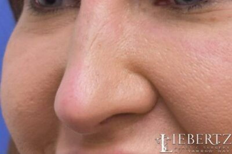 Rhinoplasty Before & After Gallery - Patient 398897 - Image 4