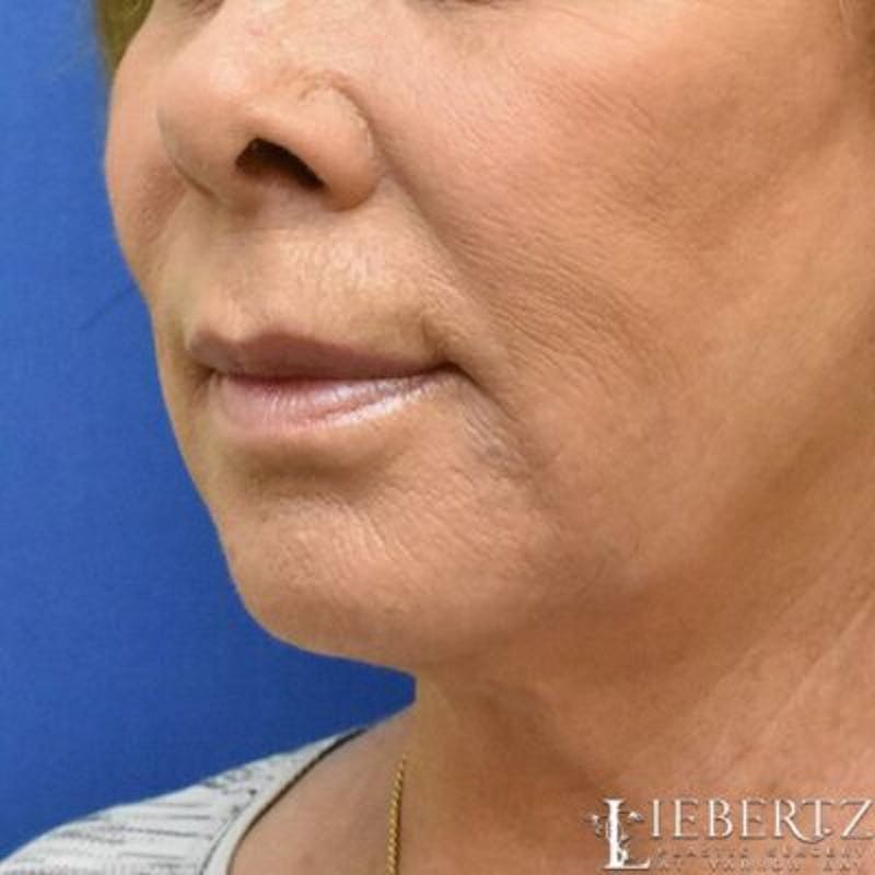 Dermal Fillers Before & After Gallery - Patient 714461 - Image 2