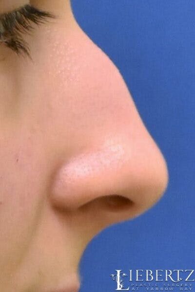 Rhinoplasty Before & After Gallery - Patient 324502 - Image 1