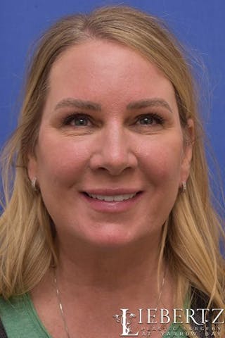 Blepharoplasty Before & After Gallery - Patient 305316 - Image 6