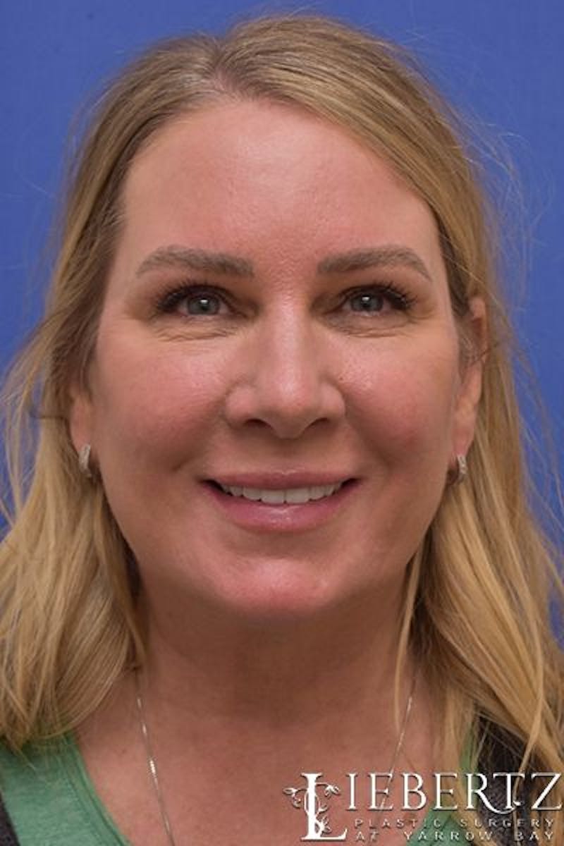Blepharoplasty Before & After Gallery - Patient 305316 - Image 6