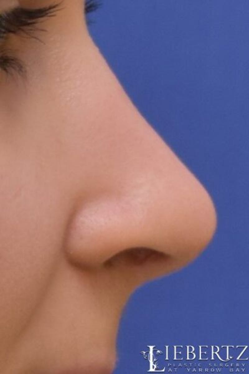 Rhinoplasty Before & After Gallery - Patient 324502 - Image 2
