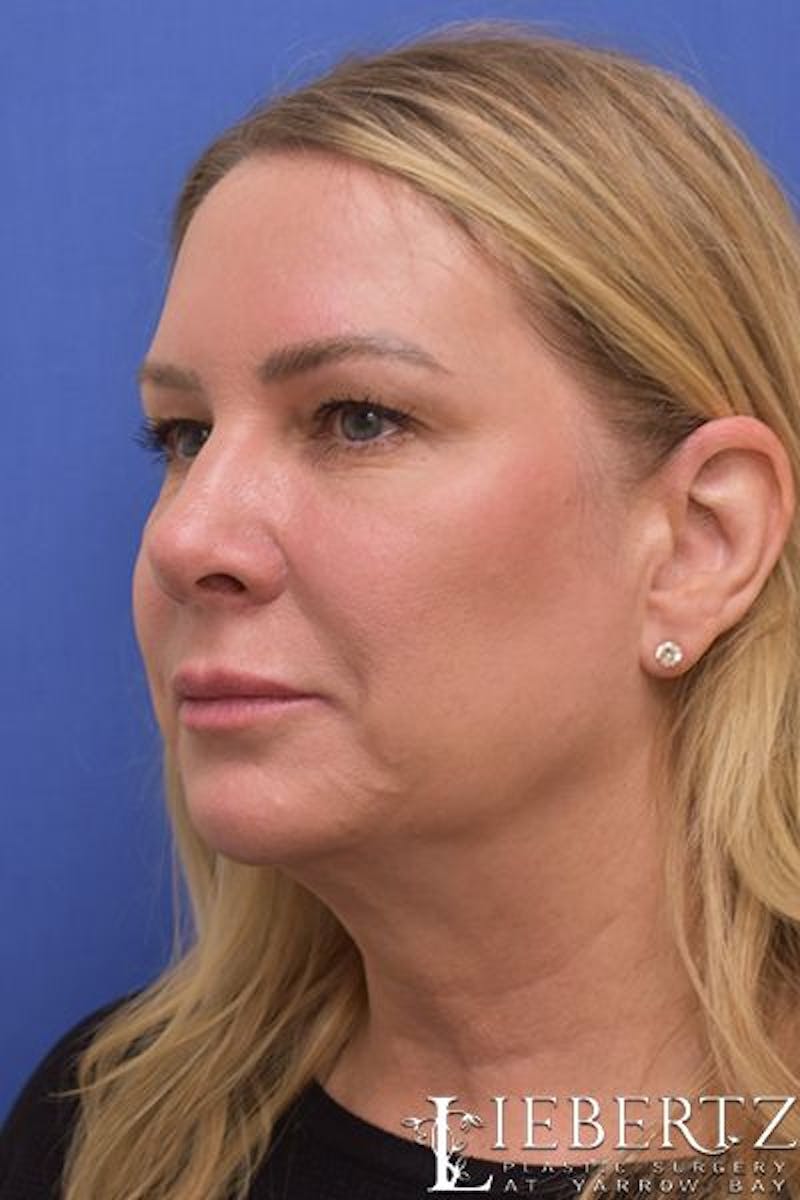 Blepharoplasty Before & After Gallery - Patient 305316 - Image 7
