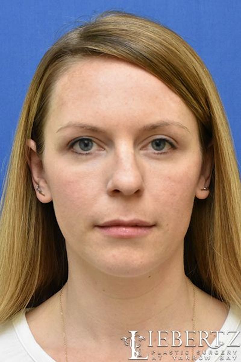 Dermal Fillers Before & After Gallery - Patient 326938 - Image 2