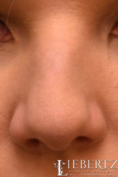 Rhinoplasty Before & After Gallery - Patient 992646 - Image 1