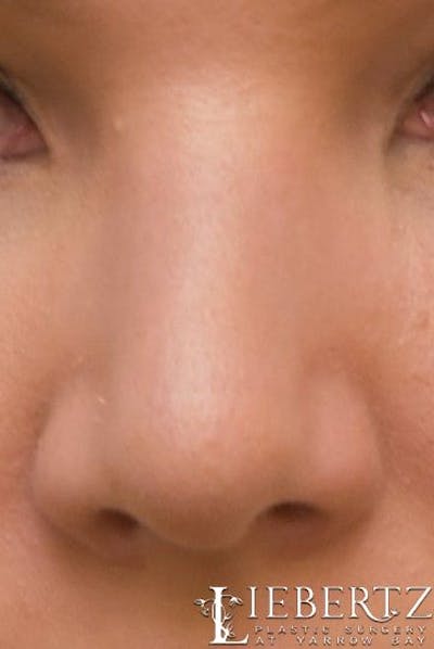 Rhinoplasty Before & After Gallery - Patient 992646 - Image 2