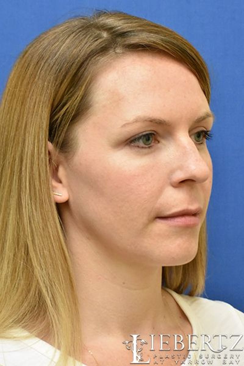 Dermal Fillers Before & After Gallery - Patient 326938 - Image 4