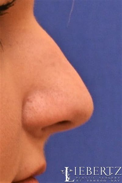 Rhinoplasty Before & After Gallery - Patient 992646 - Image 1