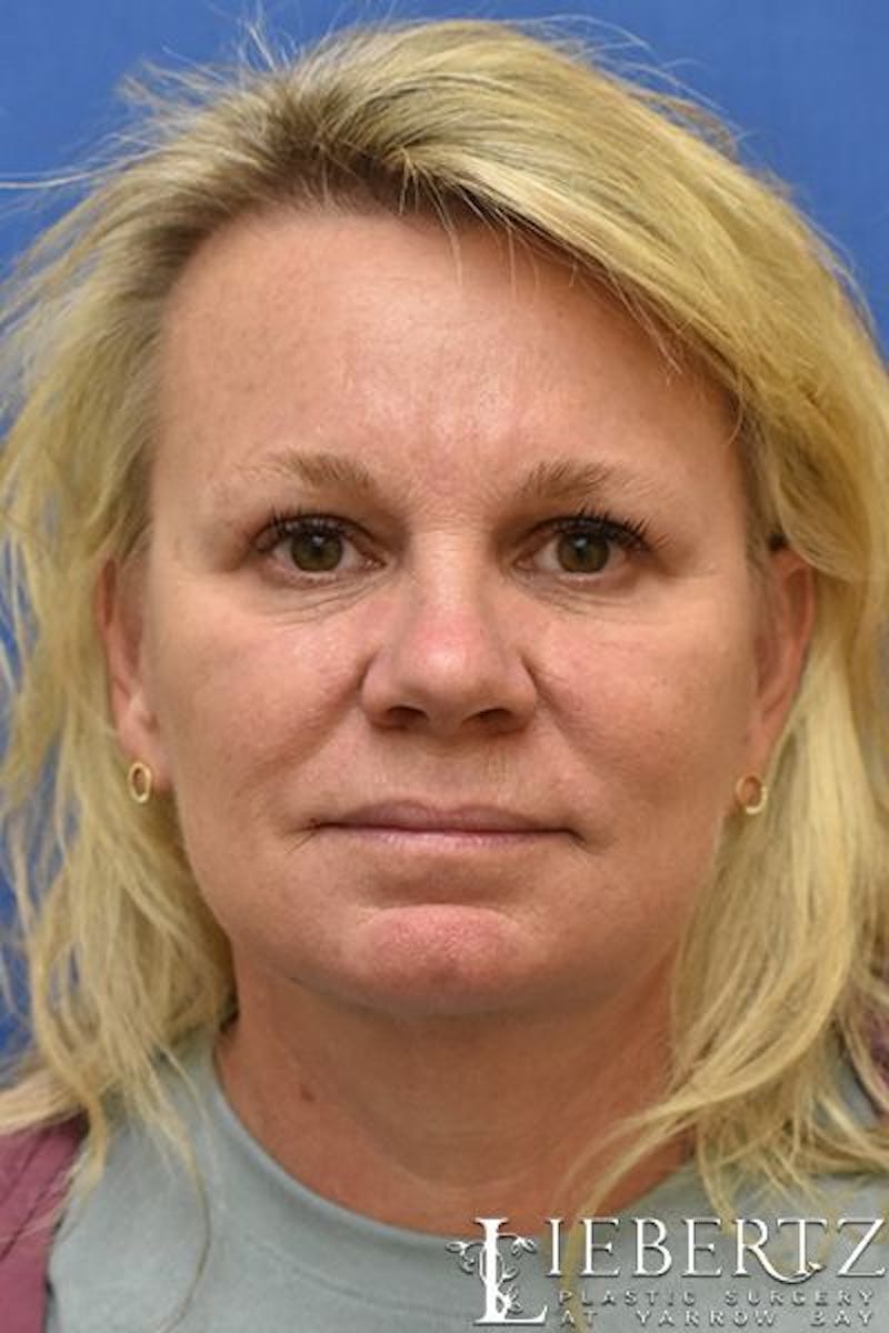 Blepharoplasty Before & After Gallery - Patient 393688 - Image 2