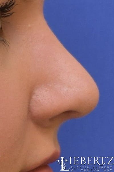 Rhinoplasty Before & After Gallery - Patient 992646 - Image 2