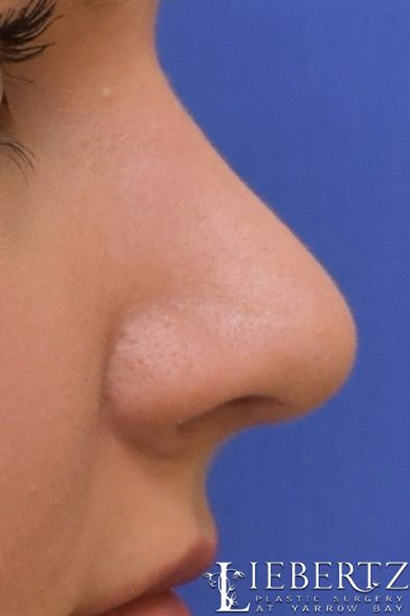 Rhinoplasty Before & After Gallery - Patient 992646 - Image 4