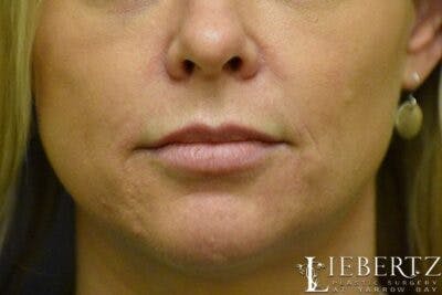 Dermal Fillers Before & After Gallery - Patient 393760 - Image 1